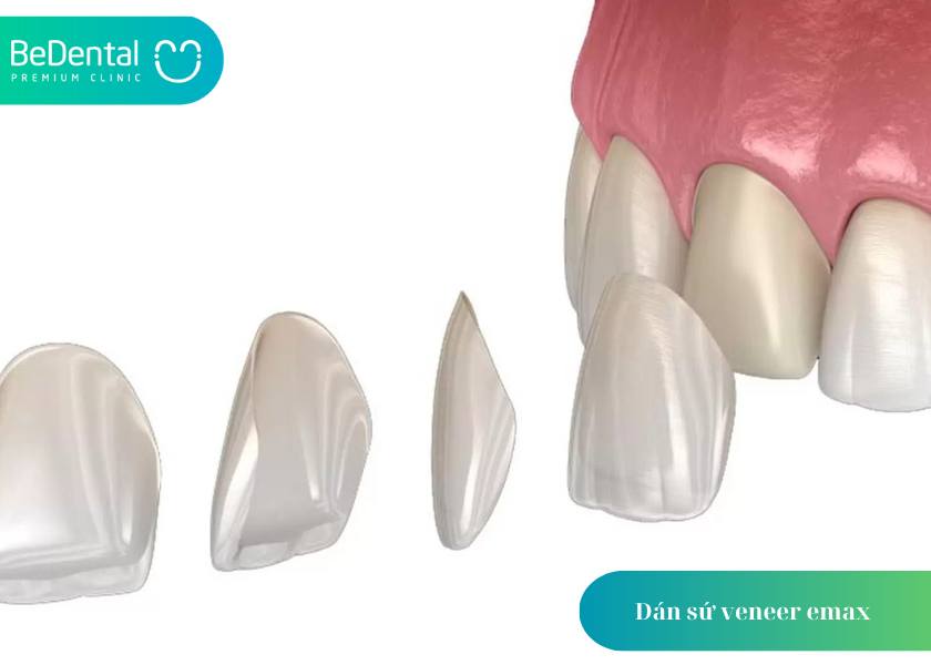 Dán sứ veneer emax