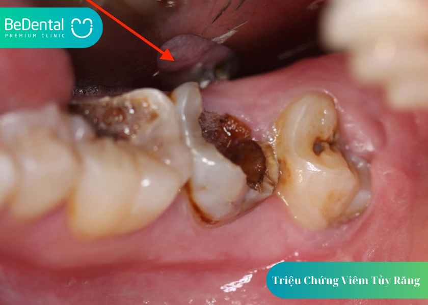 Triệu Chứng Viêm Tủy Răng: Cách Nhận Biết, Điều Trị Và Ngăn Ngừa Biến Chứng 2 Triệu Chứng Viêm Tủy Răng