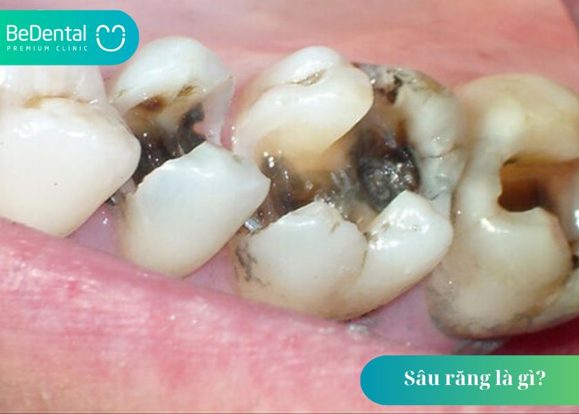 Sâu răng là gì? Mối nguy hại từ căn bệnh tưởng chừng đơn giản 2 1 9