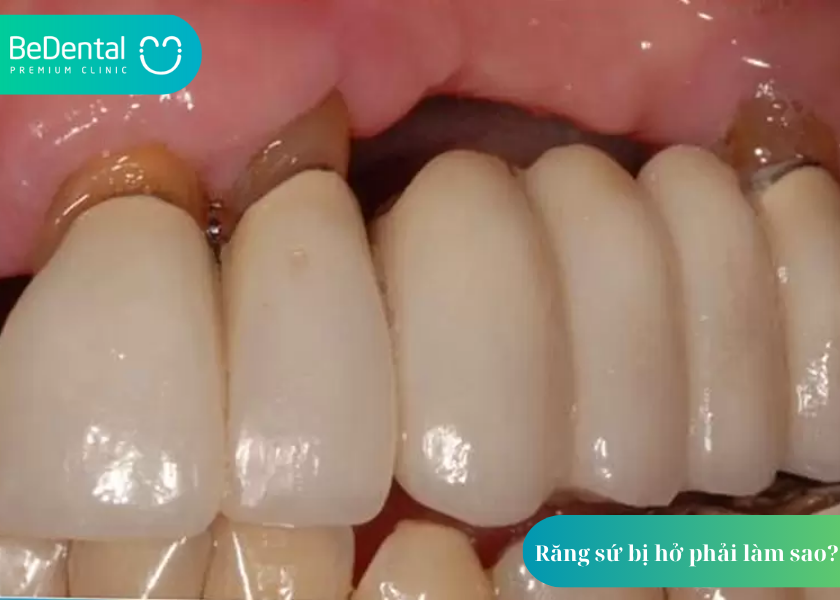 Răng sứ bị hở phải làm sao? Giải pháp từ chuyên gia nha khoa 3 Răng sứ bị hở phải làm sao?