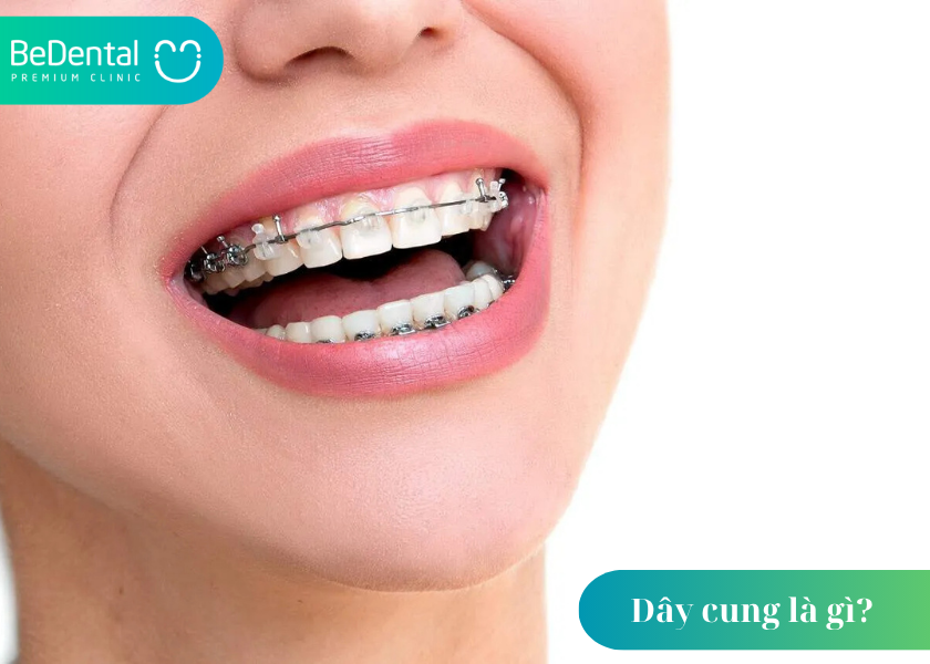 Dây cung là gì? Tìm hiểu chi tiết về vai trò của dây niềng trong chỉnh nha 4 Dây cung là gì ?