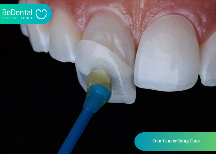 Dán Veneer Răng Thưa