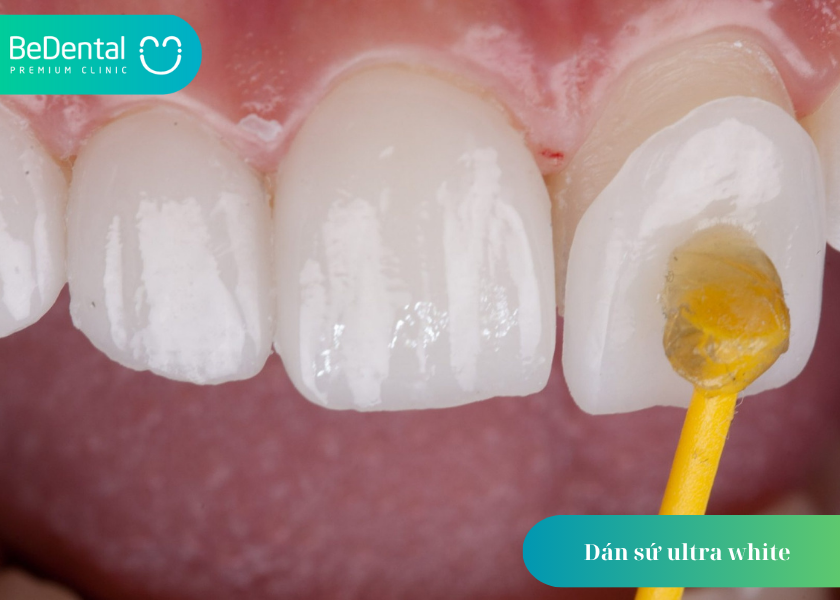 Dán sứ ultra white