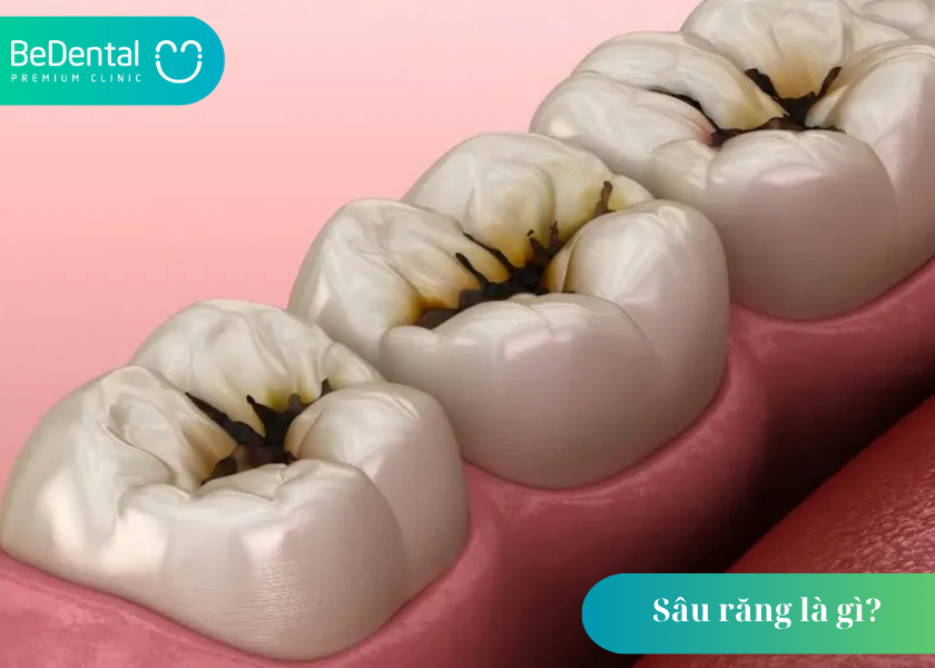 Sâu răng là gì? Mối nguy hại từ căn bệnh tưởng chừng đơn giản 3 Sâu răng là gì?