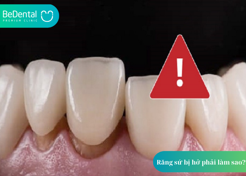Răng sứ bị hở phải làm sao? Giải pháp từ chuyên gia nha khoa 5 Răng sứ bị hở phải làm sao?