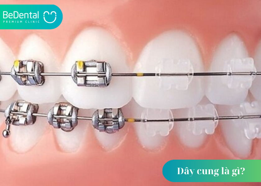 Dây cung là gì? Tìm hiểu chi tiết về vai trò của dây niềng trong chỉnh nha 2 Dây cung là gì ?