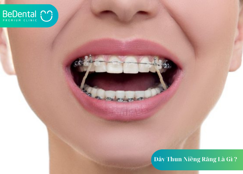Dây Thun Niềng Răng Là Gì