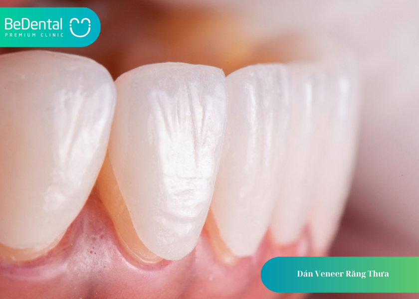 Dán Veneer Răng Thưa