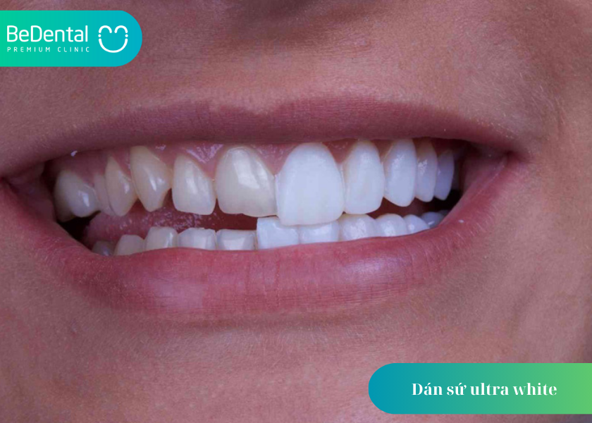 Dán sứ ultra white