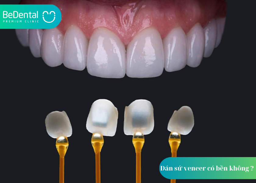 Dán sứ veneer có bền không