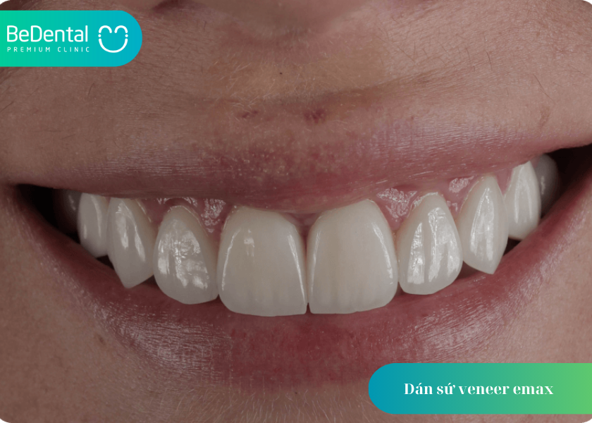 Dán sứ veneer emax