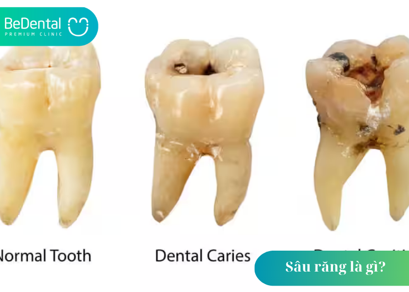 Sâu răng là gì? Mối nguy hại từ căn bệnh tưởng chừng đơn giản 4 Sâu răng là gì?