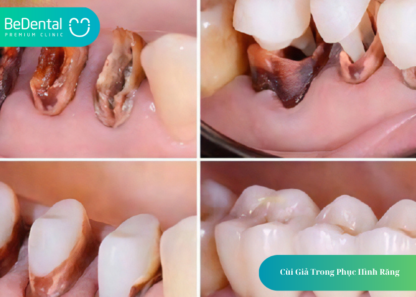 Cùi Giả Trong Phục Hình Răng