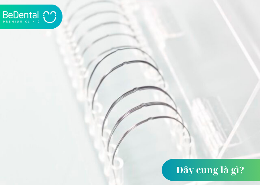 Dây cung là gì? Tìm hiểu chi tiết về vai trò của dây niềng trong chỉnh nha 5 Dây cung là gì ?