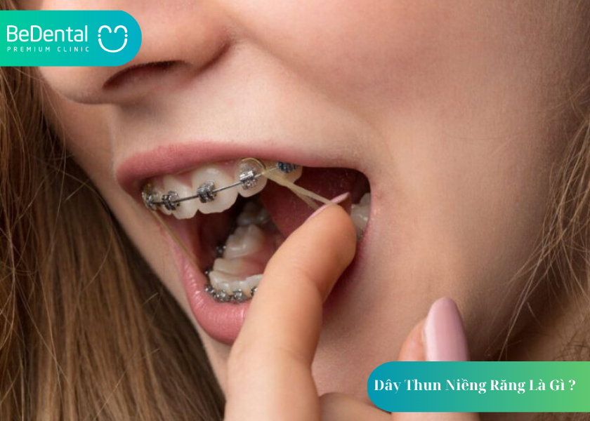 Dây Thun Niềng Răng Là Gì