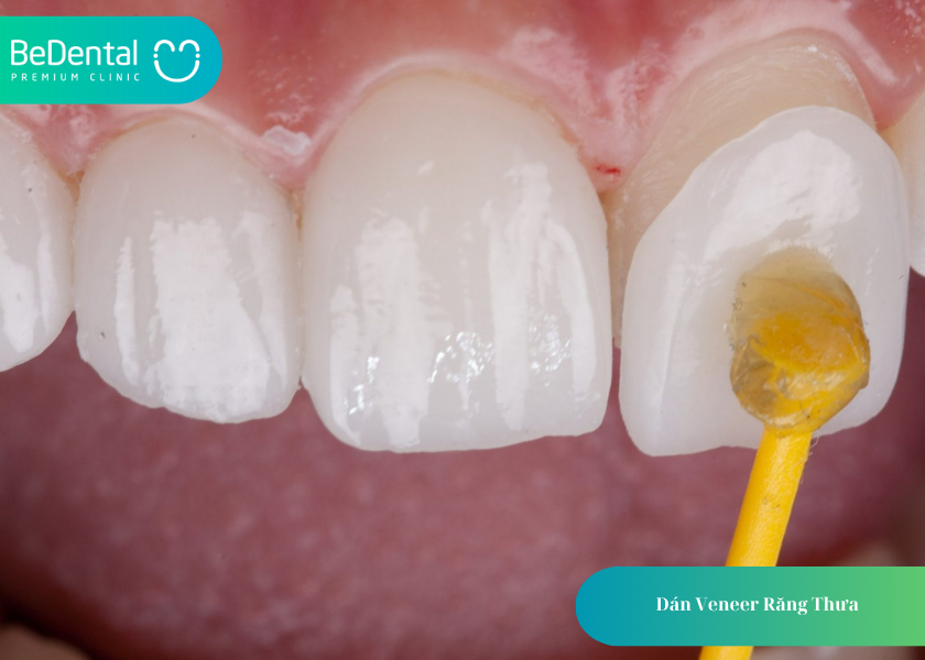 Dán Veneer Răng Thưa