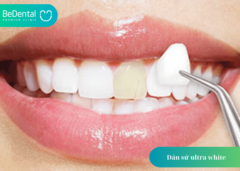Dán sứ ultra white
