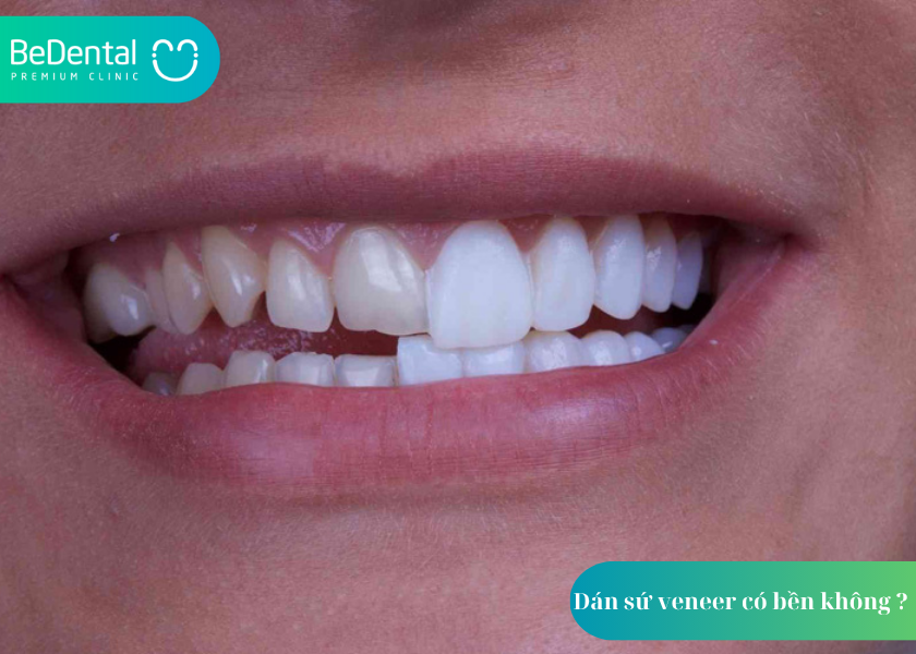 Dán sứ veneer có bền không