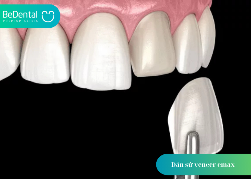 Dán sứ veneer emax