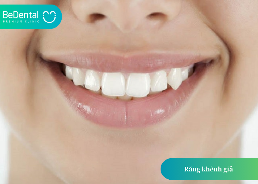 răng khênh giả