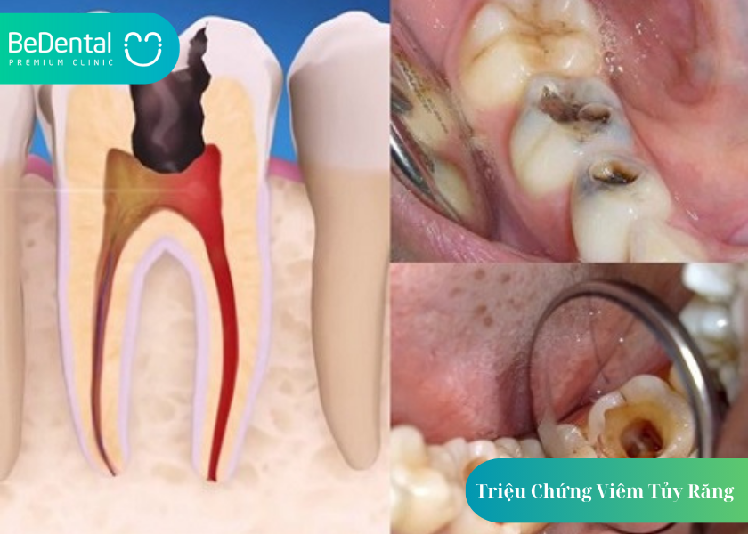 Triệu Chứng Viêm Tủy Răng