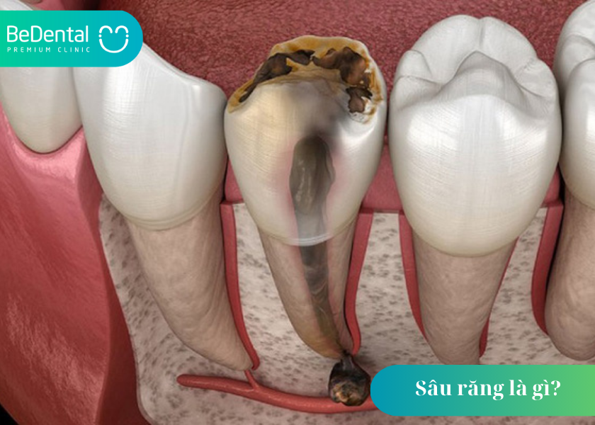 Sâu răng là gì? Mối nguy hại từ căn bệnh tưởng chừng đơn giản 5 Sâu răng là gì?