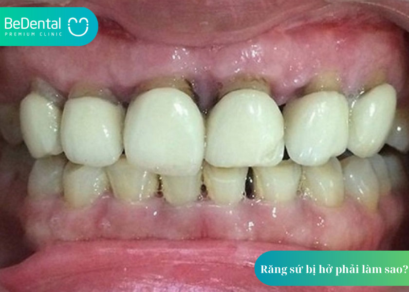 Răng sứ bị hở phải làm sao? Giải pháp từ chuyên gia nha khoa 2 Răng sứ bị hở phải làm sao?