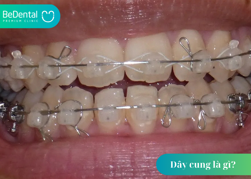 Dây cung là gì? Tìm hiểu chi tiết về vai trò của dây niềng trong chỉnh nha 6 Dây cung là gì ?