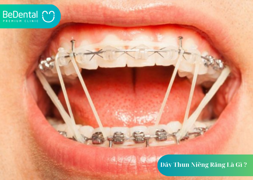 Dây Thun Niềng Răng Là Gì