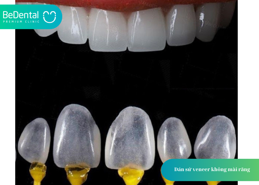 Dán sứ veneer không mài răng – Giải pháp thẩm mỹ hiện đại, an toàn tại BeDental 4 dán sứ veneer không mài răng