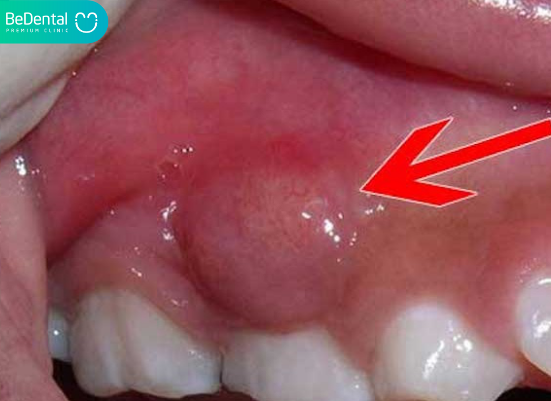 Răng chết tủy - Những điều bạn cần biết 3 Răng chết tủy