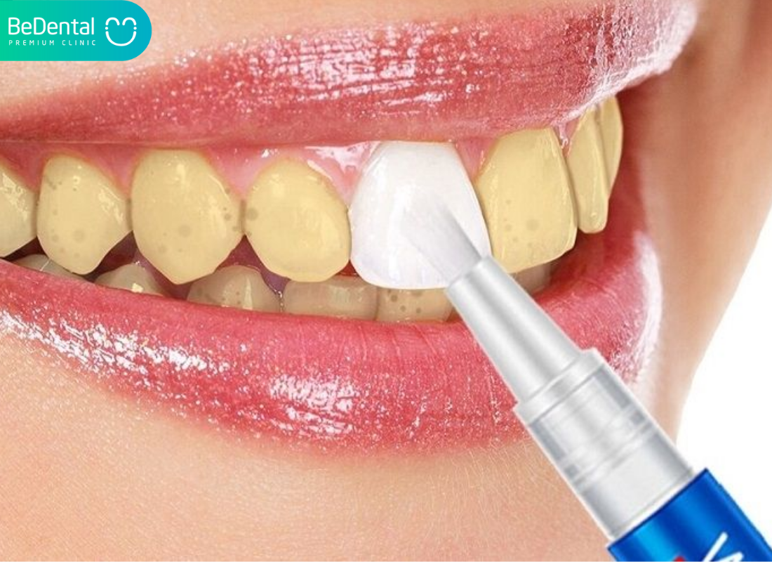 Bút tẩy trắng răng của mỹ