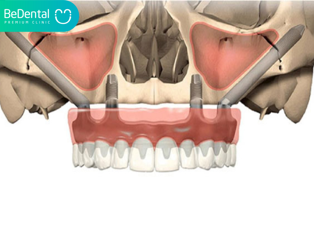 cầu răng và implant