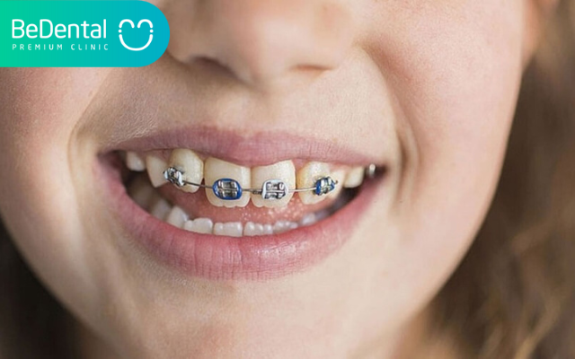 Niềng 2 răng cửa có được không?