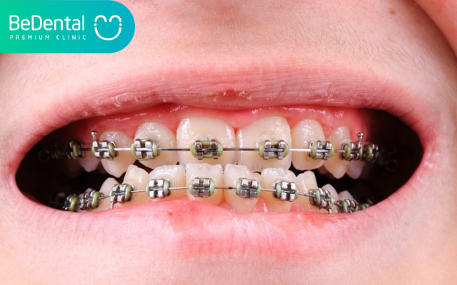 Sâu răng có niềng răng được không? 2 Sâu răng có niềng răng được không?