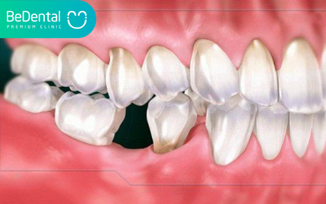 Niềng răng bị tiêu xương phải làm sao? 4 Niềng răng bị tiêu xương
