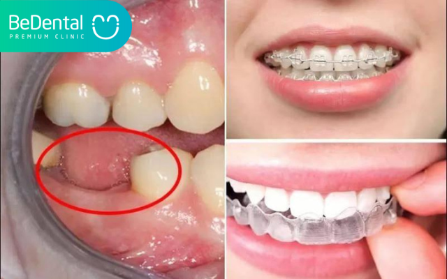 Niềng răng bị tiêu xương phải làm sao? 6 Niềng răng bị tiêu xương