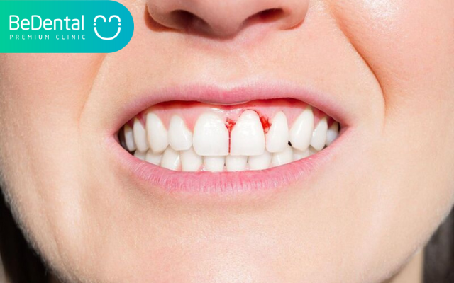 Thuốc bôi viêm lợi 4 Thuốc bôi viêm lợi