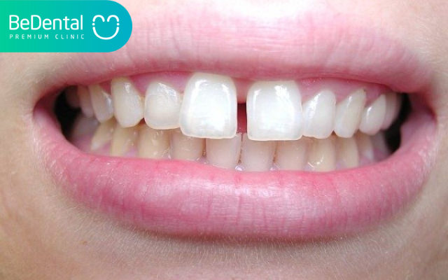 Niềng 2 răng cửa có được không?