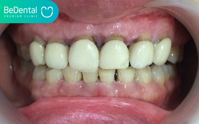 Tháo răng sứ có đau không? 5 Tháo răng sứ có đau không?