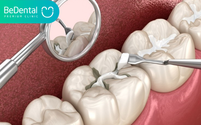 Bị sâu răng phải làm sao?