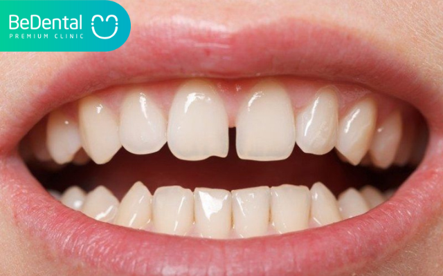Niềng 2 răng cửa có được không?