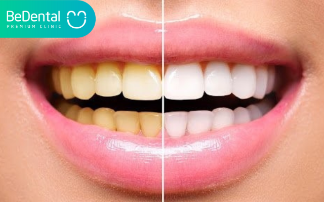 Tẩy trắng răng bằng đèn plasma 3 Tẩy trắng răng bằng đèn Plasma