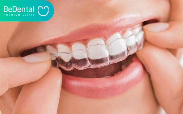 Sâu răng có niềng răng được không? 5 Des be ag 8