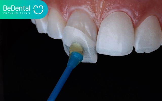 Tác hại của dán răng sứ khi thực hiện sai kỹ thuật 2 Tác hại của dán răng sứ