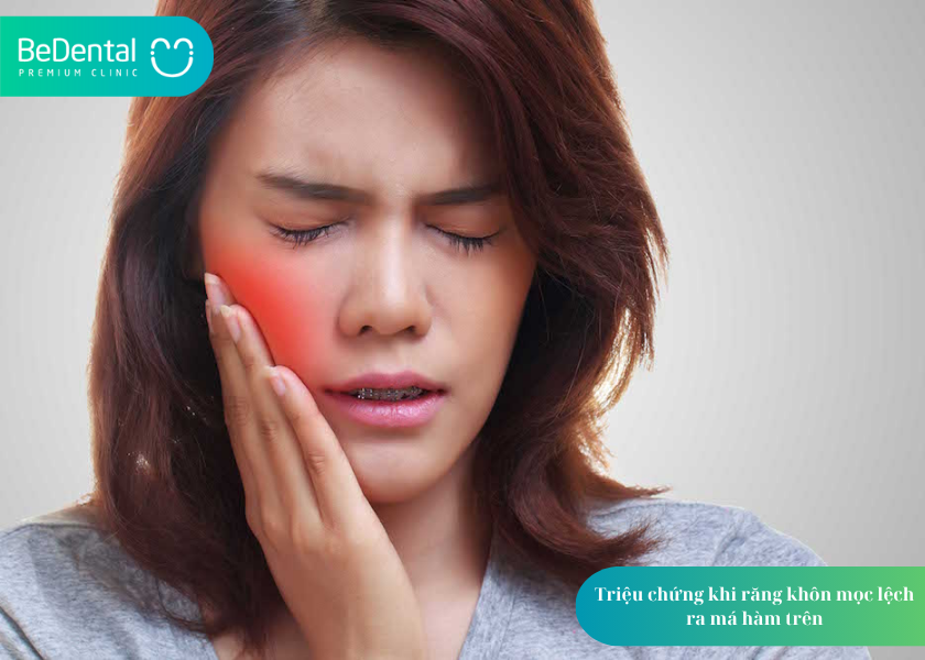 Răng Khôn Mọc Lệch Ra Má Hàm Trên: Tác Hại Và Cách Xử Lý 2 răng khôn mọc lệch ra má hàm trên