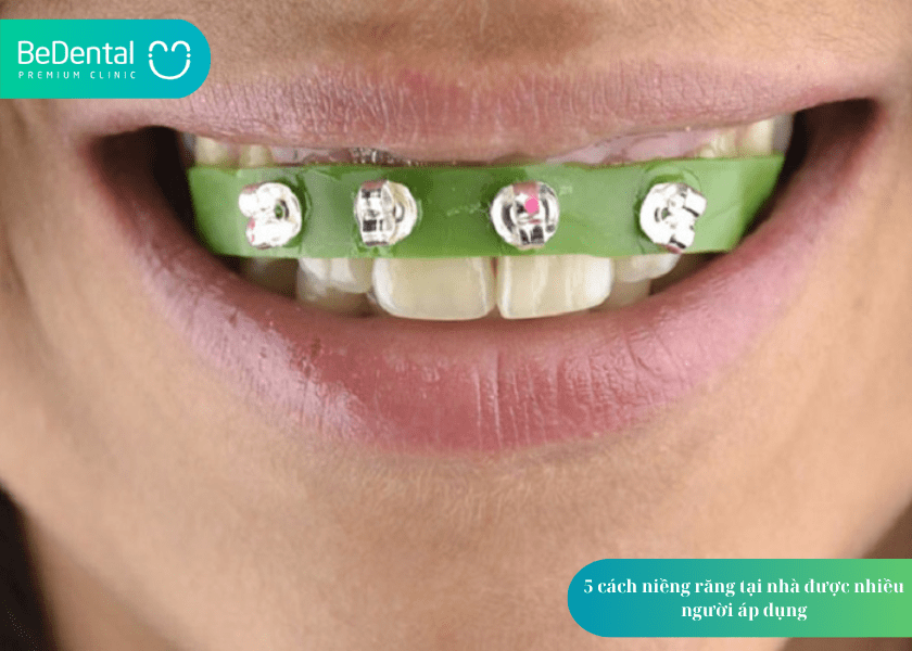 Niềng răng tại nhà: Giải pháp an toàn hay tiềm ẩn rủi ro? 2 5 cách niềng răng tại nhà được nhiều người áp dụng