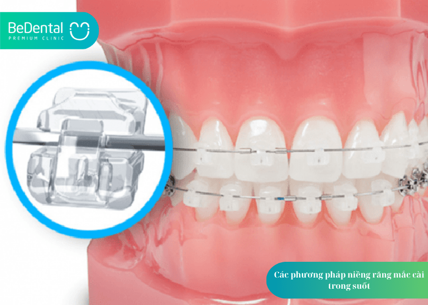 Niềng răng mắc cài trong suốt: Giải pháp chỉnh nha hiện đại, thẩm mỹ và tiện lợi 2 Mắc cài trong suốt