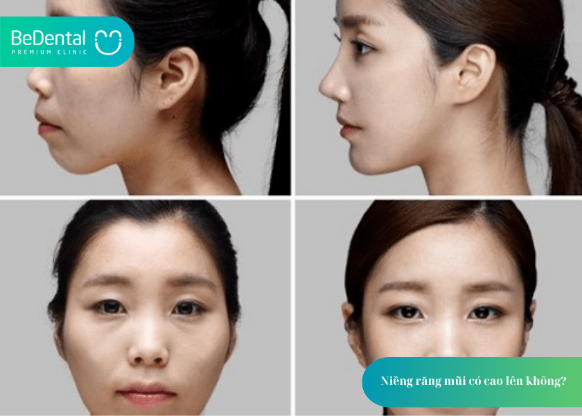 Niềng răng mũi có cao lên không? Hiểu đúng về tác động của niềng răng đến khuôn mặt 2 Niềng răng mũi có cao lên không?