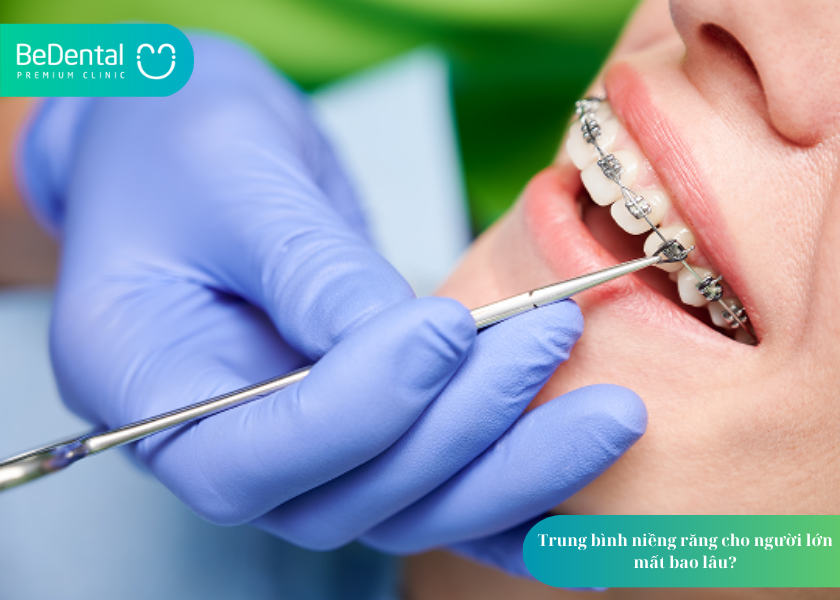 Niềng răng cho người lớn mất bao lâu? Giải đáp chi tiết từ chuyên gia 3 How much does teeth whitening cost 1